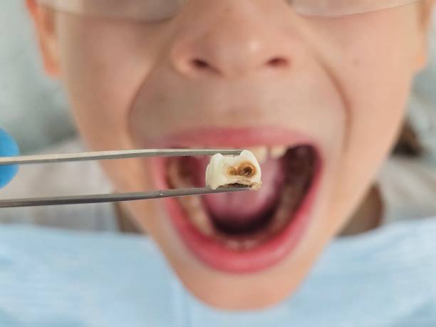 Best Emergency Dentist for Lost Fillings or Crowns in Oakland, SC
